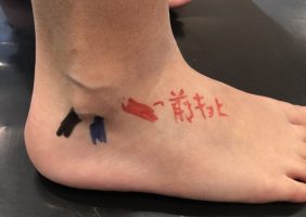 足関節外側靭帯損傷